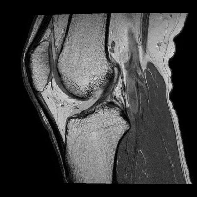 снимок МРТ коленного сустава